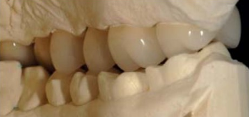 Поступательное моделирование зубных рядов в сложных клинических случаях