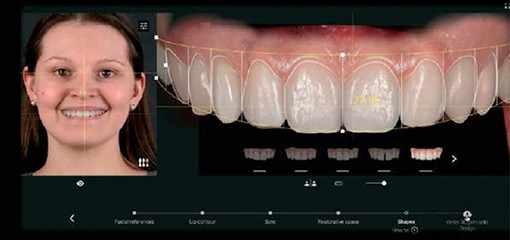 Цифровые технологии в стоматологии на этапах планирования ортопедического лечения