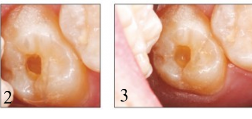 Что такое биоактивная стоматология? Обзор