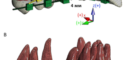 Биомеханические особенности перемещения зубов с помощью лингвальной аппаратуры в сравнении с вестибулярной аппаратурой при закрытии пространств механикой скольжения