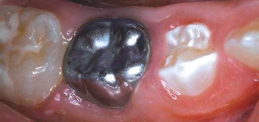 Пульпотомия временных зубов ЦОЭ и MTA: потенциально менее токсичная альтернатива формокрезолу