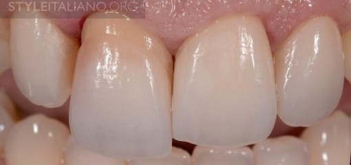 Оптимизация реставрации передних окрашенных зубов с помощью керамических виниров