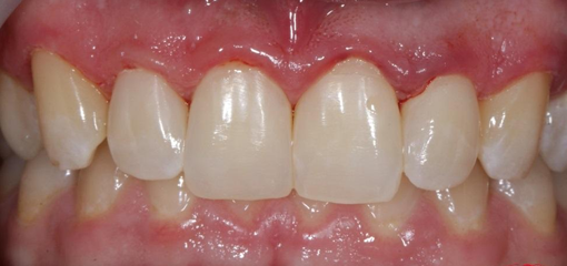 Восстановление эстетики фронтальной группы зубов в одно посещение