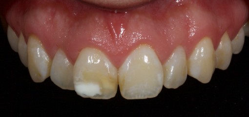 Ультраконсервативный подход к дисколориту зубов