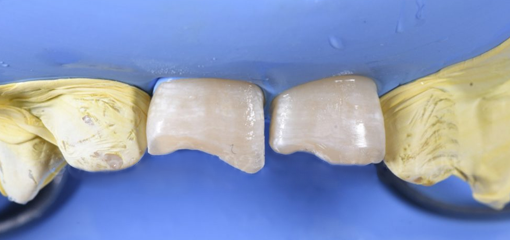 Простой подход к лечению зубов с механической травмой путем прямой композитной реставрации