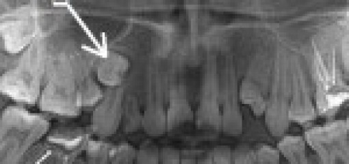 Диагностика и комплексное лечение детей с ретенцией постоянных зубов при лечении с опорой на ортодонтические имплантаты