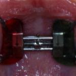 Скученность верхних латеральных резцов: простая процедура, не затрагивающая постоянные зубы
