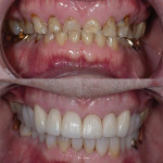 Поэтапное восстановление стертых зубов при сильном наклоне окклюзионной плоскости с помощью системы систематического управления