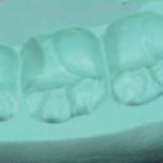 Поступательное моделирование зубных рядов в сложных клинических случаях