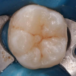 Применение силиконового шаблона в ежедневной практике врача-стоматолога терапевта