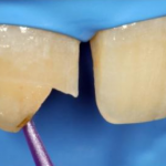 Клиническое и научное руководство по реплантации отломков зуба
