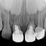 Обтурация корневых каналов временных зубов