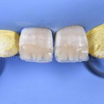 Простой подход к лечению зубов с механической травмой путем прямой композитной реставрации