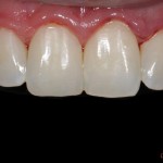 Восстановление эстетики фронтальной группы зубов в одно посещение