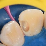 Советы и хитрости при лечении проксимального кариеса передних зубов