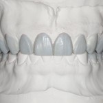 Эстетическая реабилитация улыбки у немотивированного пациента с патологической стираемостью