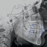 Комплексный подход СRANIO: ортодонтия и имплантация