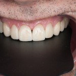 Особенности финишной обработки культи зуба