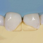 Моделирование зубов с применением уникальной матрицы