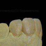 Восстановление эндодонтически леченных зубов с помощью непрямых композитных реставраций
