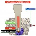 Нехирургическое эндодонтическое перелечивание верхнего центрального резца с открытым апексом техникой апикальной пробки из МТА