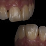Техника “крыла” для реставрации фронтальной группы зубов