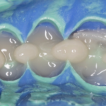 Приемы восстановления больших дефектов жевательных зубов. Метод окклюзионной модели