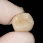 Клинический случай: эндо-ресто с привлечением цифровой стоматологии