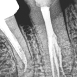 Лечение премоляра нижней челюсти с глубоким разветвлением корневых каналов