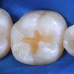 Реставрации боковой группы зубов. Какую консистенцию выбрать?
