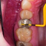 Микроинвазивный подход к лечению с учетом особенностей биомеханики зубов