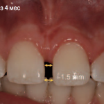 Лазерная френэктомия в детской стоматологии
