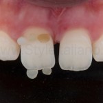 Протокол лечения диастемы: минимальное ортодонтическое вмешательство с последующей прямой композитной реставрацией. Колориметрия