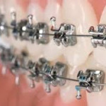 Что нового в механике на этапе завершения ортодонтического лечения?
