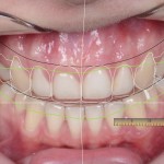 Анализ лица и улыбки - сила коммуникации при выборе формы зубов