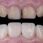 Реконтуринг зубов и совершенствование их формы