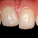 Анкилоз. Часть 3 (из 5): Лечение детей с анкилозом постоянных зубов