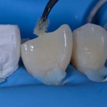 Реставрация скола коронки зуба по IV классу, осложненного отделением небного фрагмента
