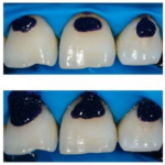 Микроабразия плюс реминерализующая терапия как минимально инвазивный подход к устранению дисколорита зубов
