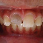 Клинический случай ревитализации зуба с использованием обогащенной фибрином плазмы