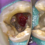 Лечение большой перфорации дна полости зуба