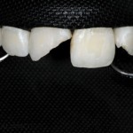 Клинический случай: сочетанное повреждение зубов (переломы коронок и неполный вывих) в результате "велосипедной травмы"
