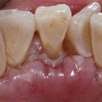 Устранение рецессии десны в области язычной поверхности фронтальных зубов