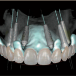 Цифровое моделирование улыбки и шаблонов для установки имплантатов и их моментальной нагрузки при частичной адентии
