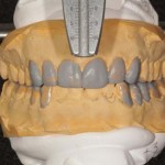Полная реабилитация полости рта с помощью прямых композитных реставраций