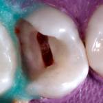 Пульпотомия в постоянном сформированном зубе. Часть 1