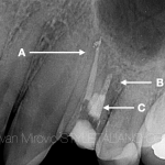Спасение безнадежного зуба: клинический случай