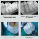 Лечение глубокого кариеса постоянных зубов