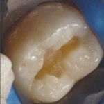 Что такое биоактивная стоматология? Обзор