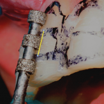 Керамические виниры: щадящее препарирование зубной эмали